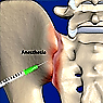 Sacroiliac Joint Steroid Injection